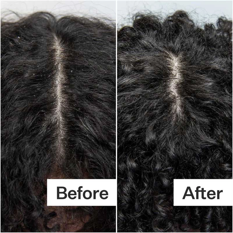 Act Acre Scalp Build-Up System